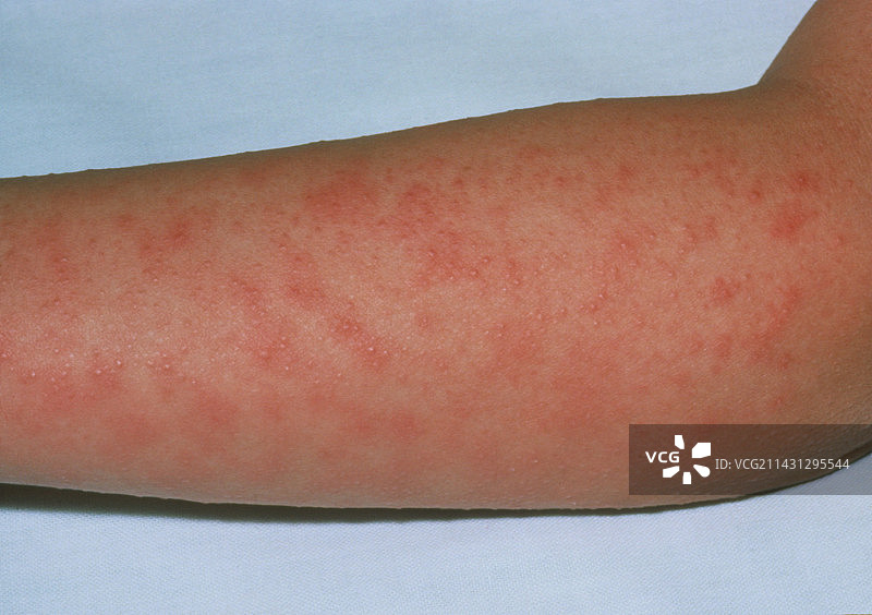 患者手臂上的猩红热皮疹图片素材