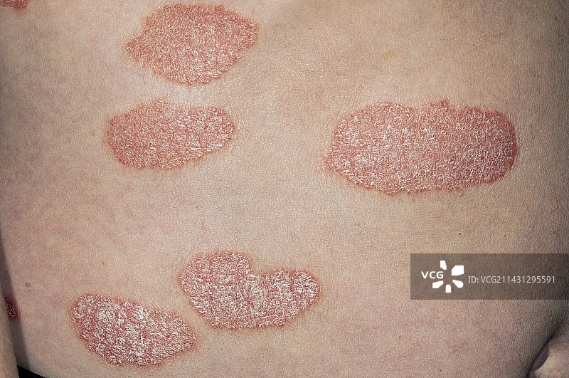 背部的斑块状银屑病图片素材