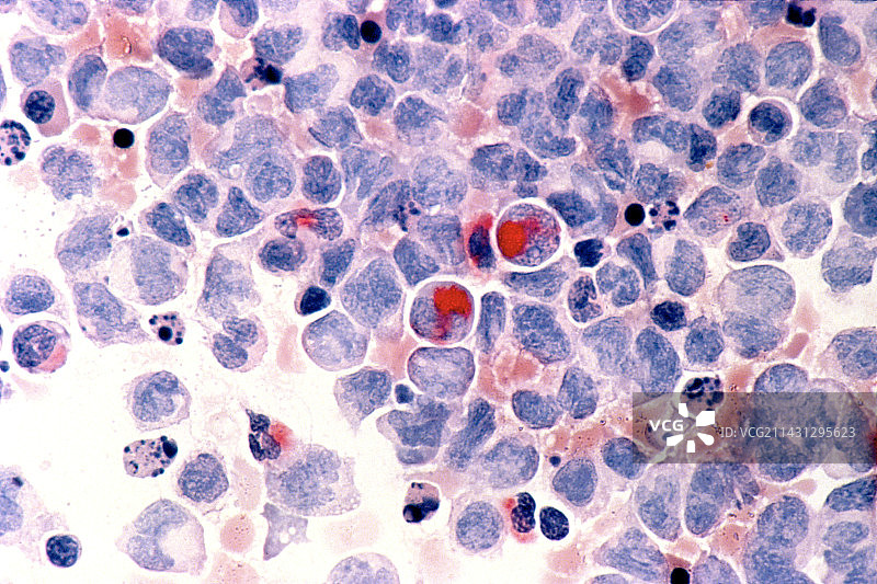 白血病血细胞显微照片图片素材