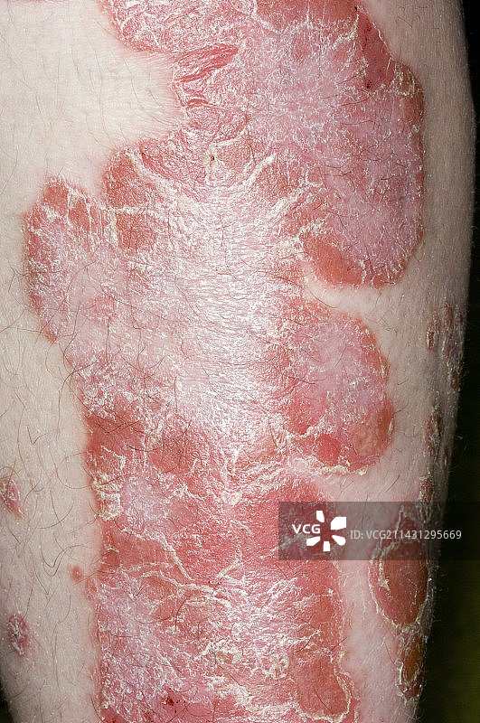 躯干上的斑块状银屑病图片素材