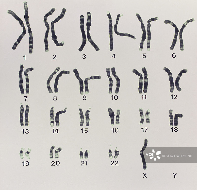 特纳综合征的核型图片素材