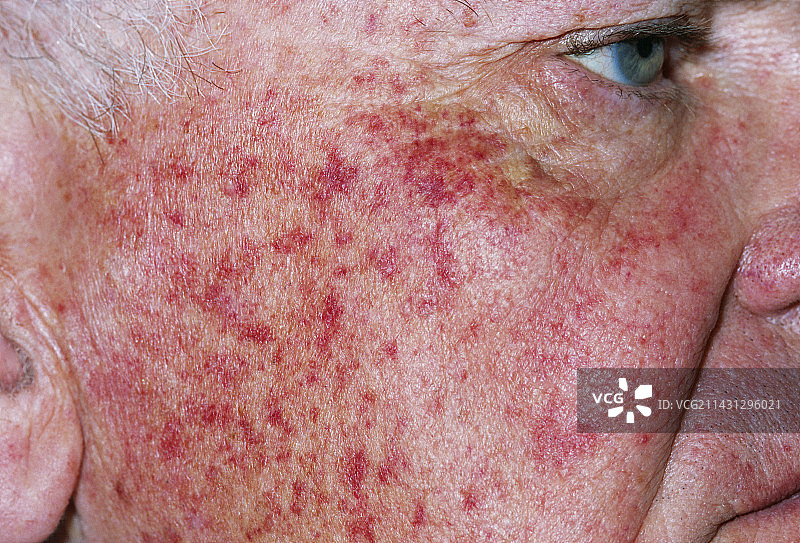 出血点疹图片素材