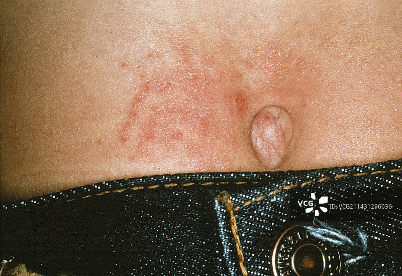 过敏性接触皮炎图片素材