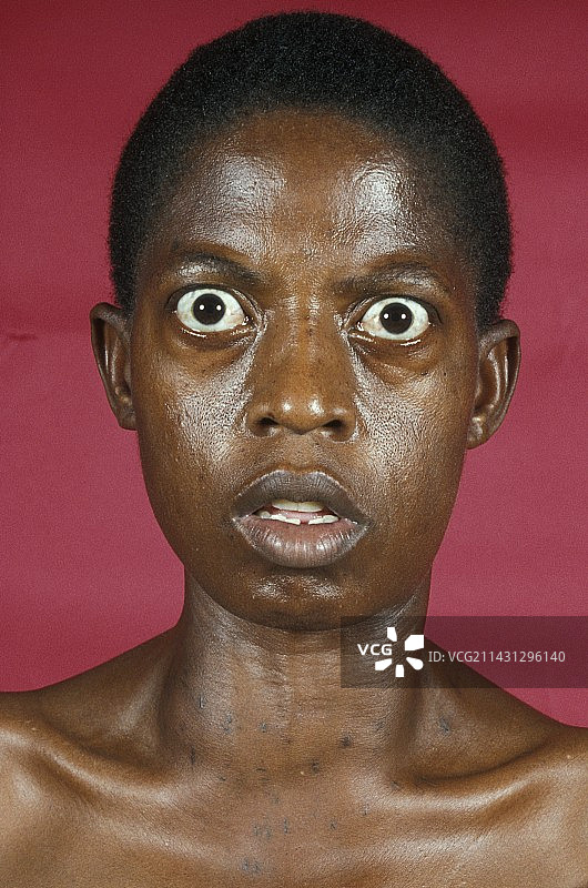 格雷夫斯病图片素材