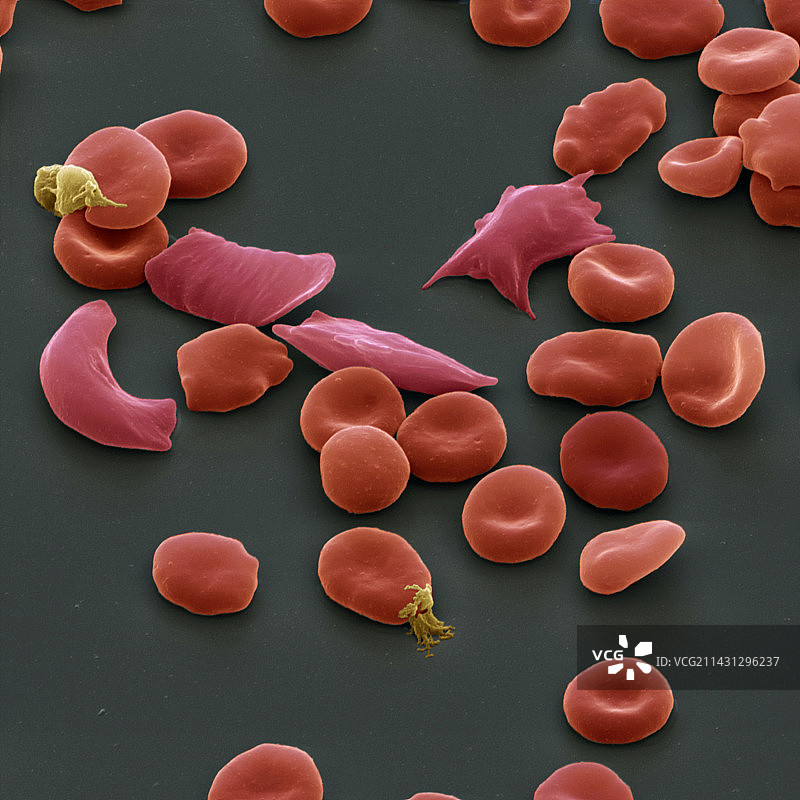 镰状细胞贫血症扫描电子显微镜图片素材