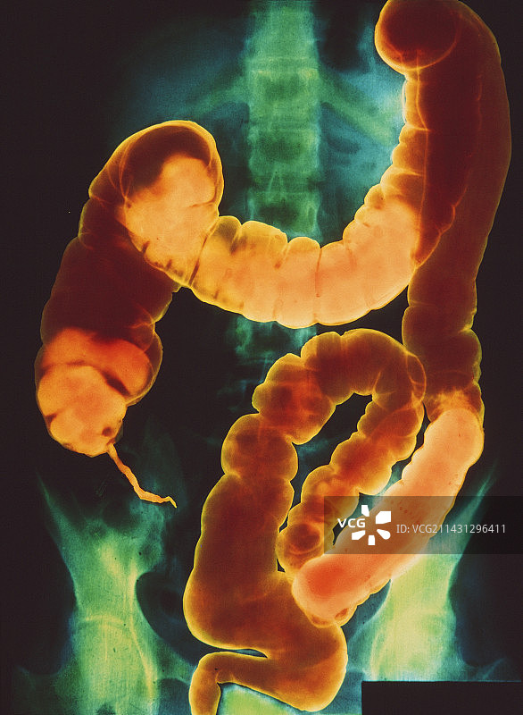 钡灌肠后结肠的伪彩色X光片图片素材