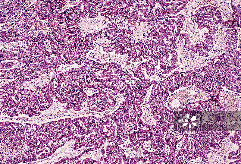 卵巢癌图片素材