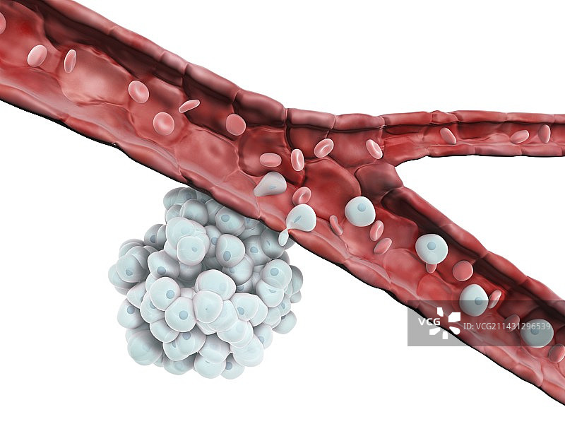 癌细胞扩散，图示图片素材