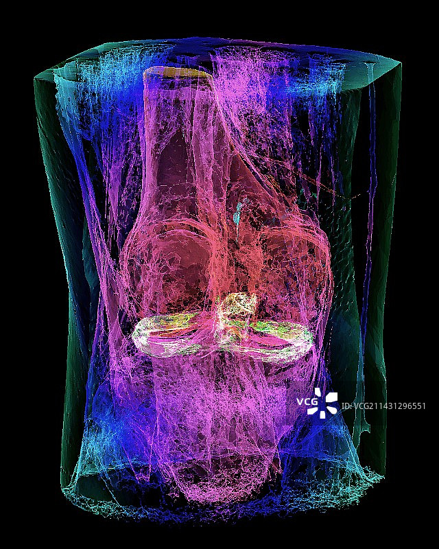 膝盖半月板和韧带的3D核磁共振扫描图片素材