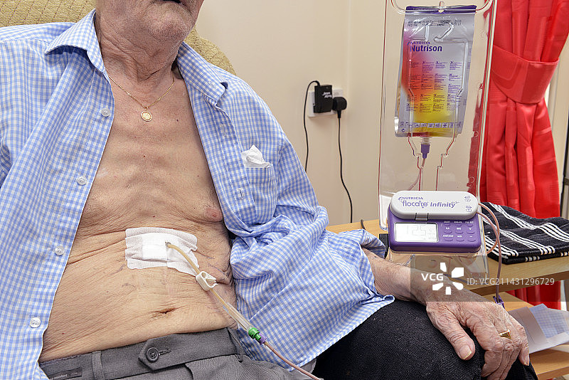 经皮内镜胃造口术图片素材