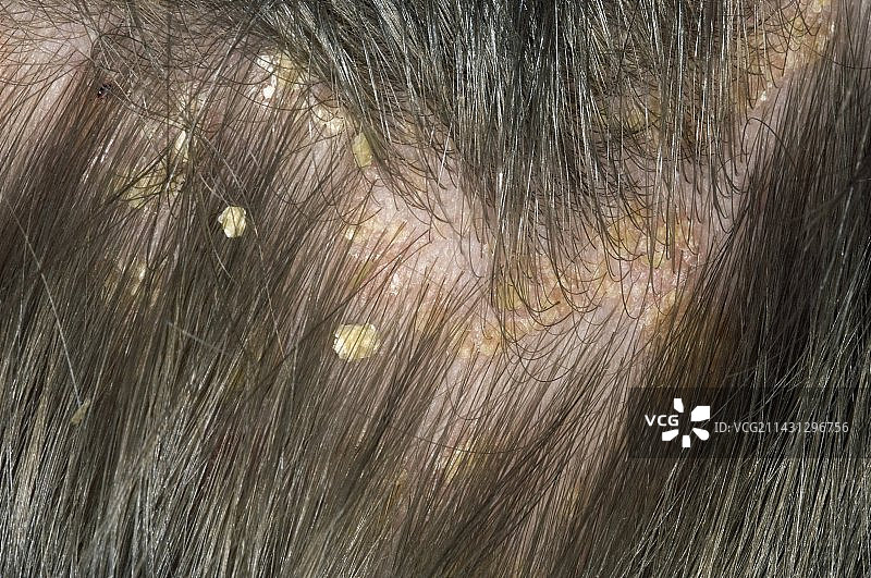 头皮上的银屑病图片素材