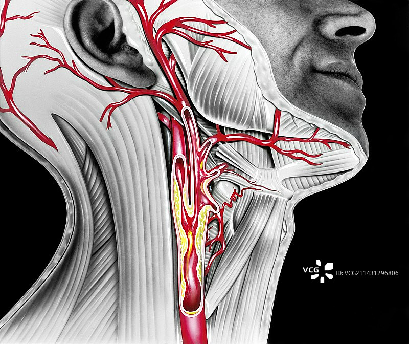 颈动脉粥样硬化艺术图图片素材