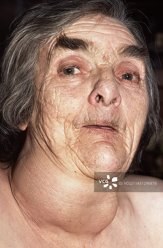 甲状腺功能减退症图片素材