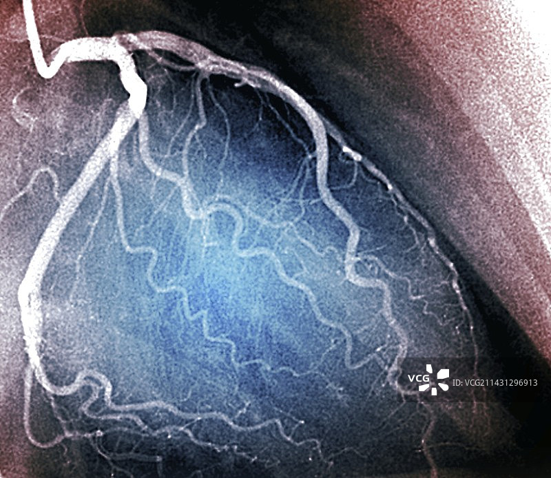 左冠状动脉造影扫描图片素材