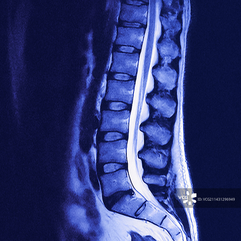 下脊柱核磁共振扫描图片素材