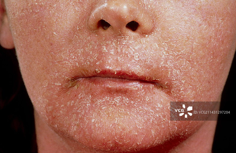 接触性皮炎图片素材