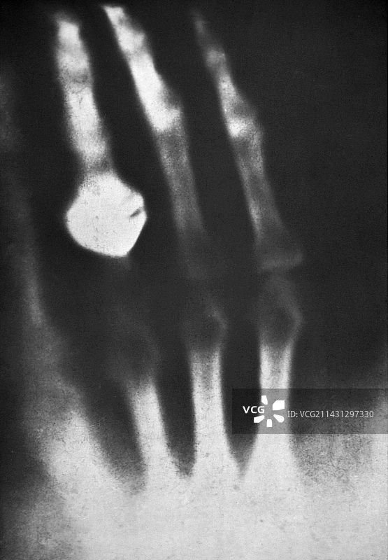 首张人类X光片图片素材