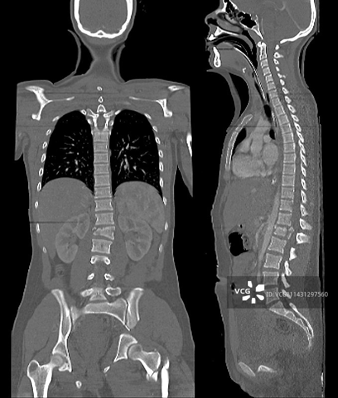 脊柱和骨盆骨折CT扫描图片素材