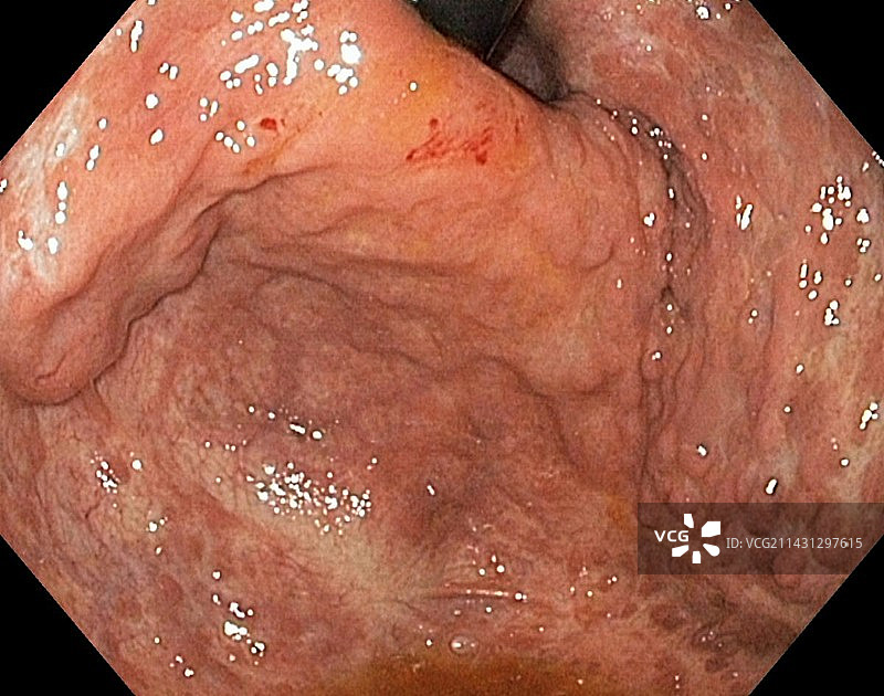 重度胃炎内窥镜视图图片素材