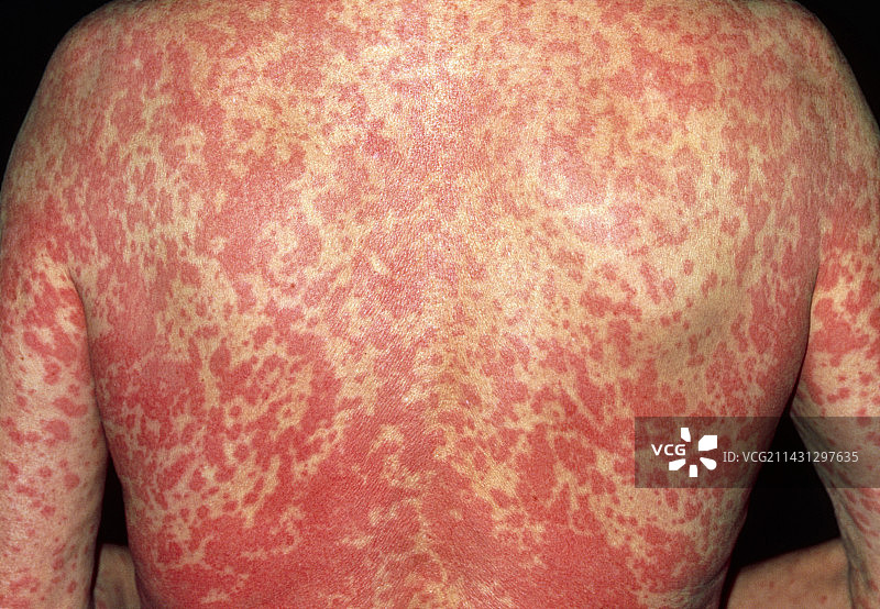 过敏引起的皮疹图片素材