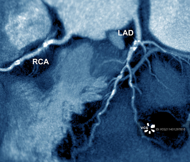 冠状动脉狭窄CT扫描图片素材