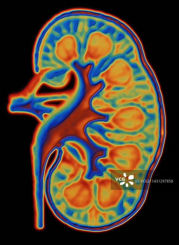 健康人肾脏的彩色CT扫描图片素材