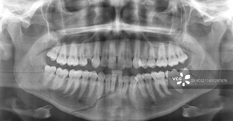 颌骨骨折X光片图片素材