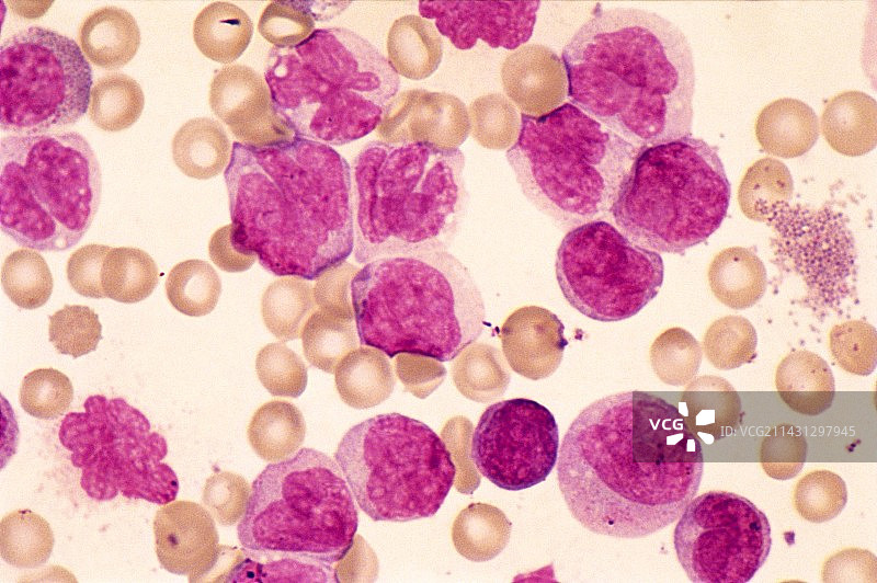 慢性粒细胞白血病显微照片图片素材