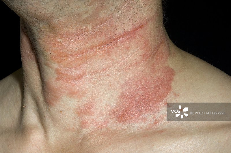 颈部湿疹图片素材
