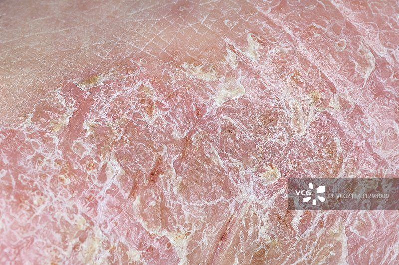 脚部湿疹图片素材