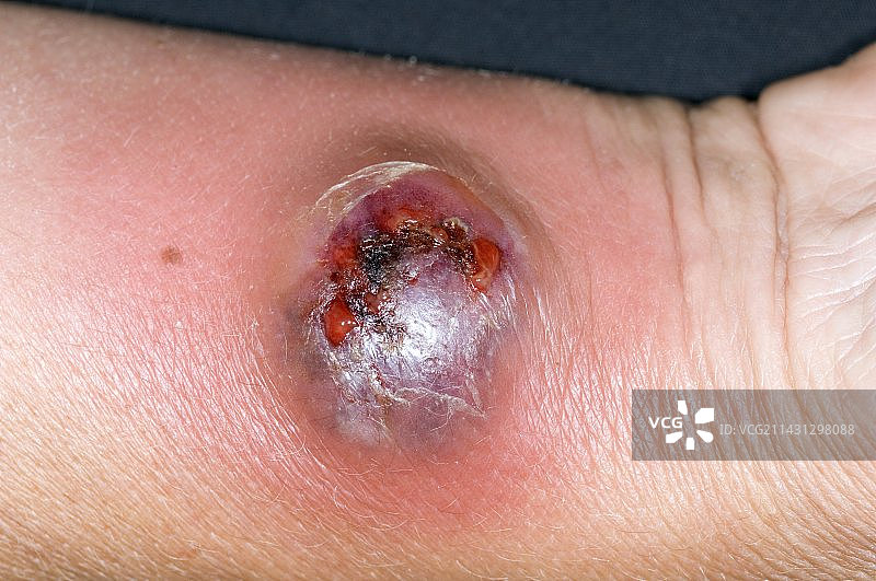 手腕脓肿图片素材