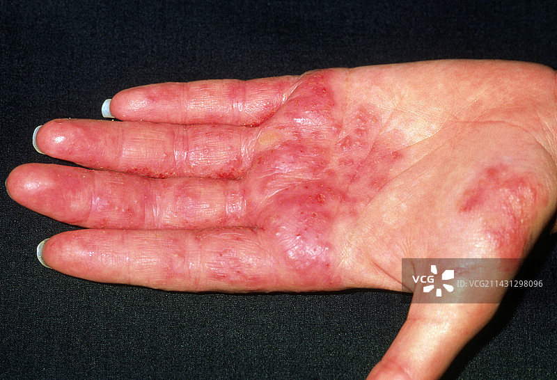 患有接触性皮炎的理发师的手图片素材