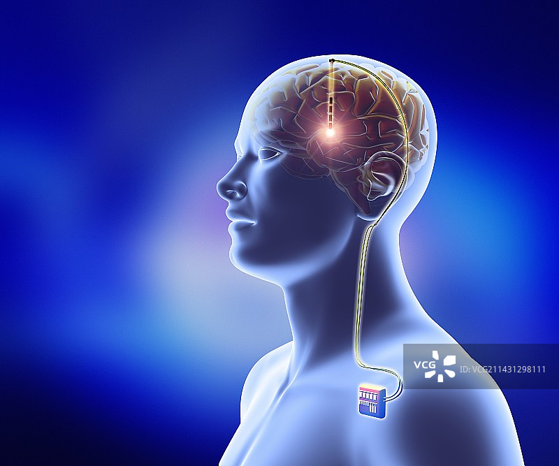 深部脑刺激艺术图图片素材