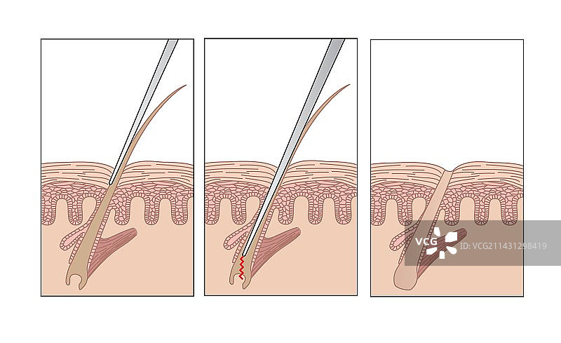电解脱毛艺术作品图片素材