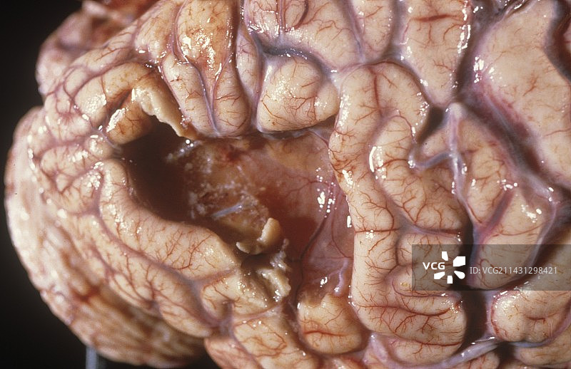 中风后的大脑图片素材