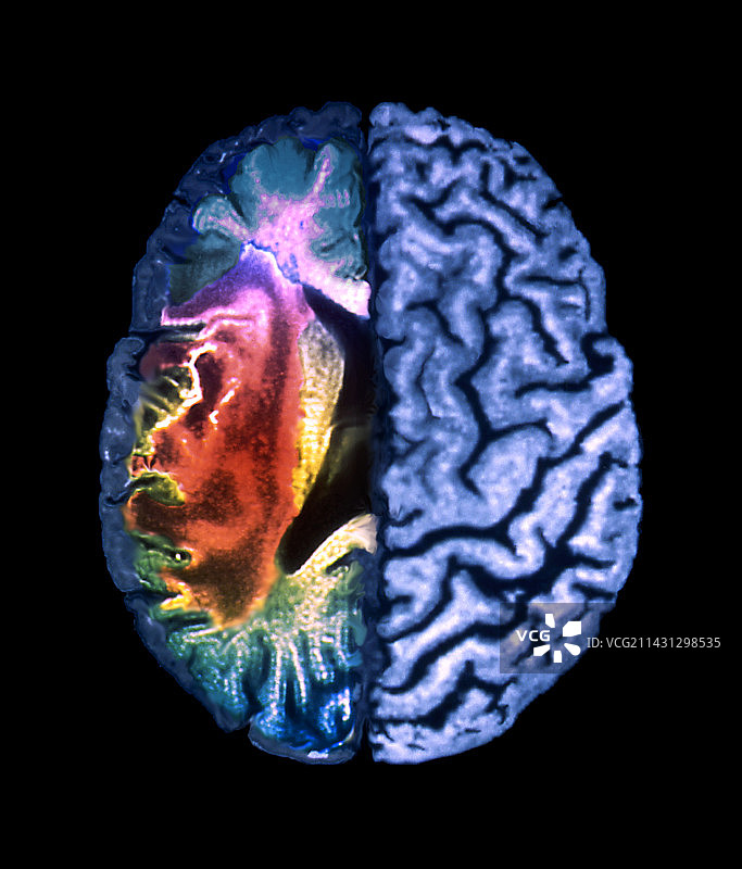 中风核磁共振扫描图片素材