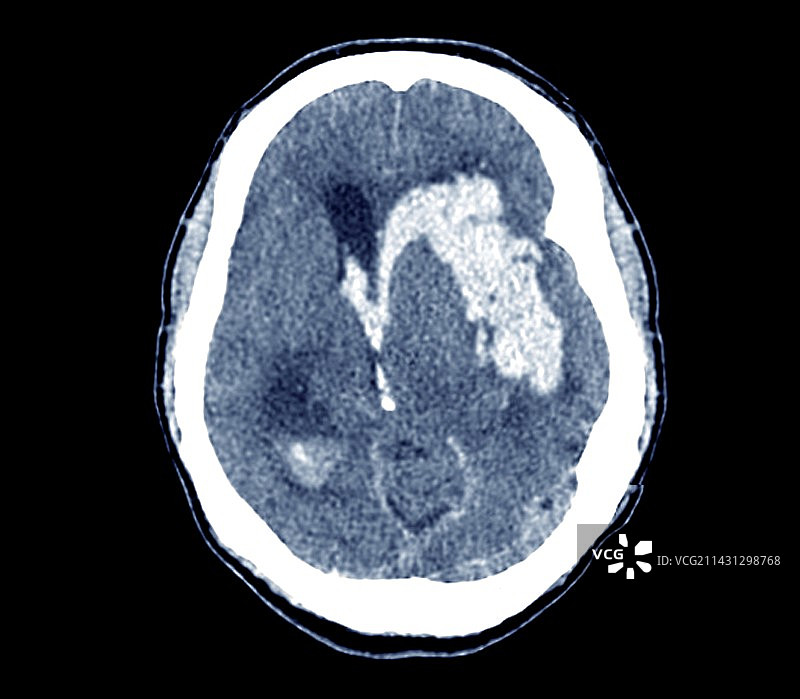 中风和脑出血CT扫描图片素材