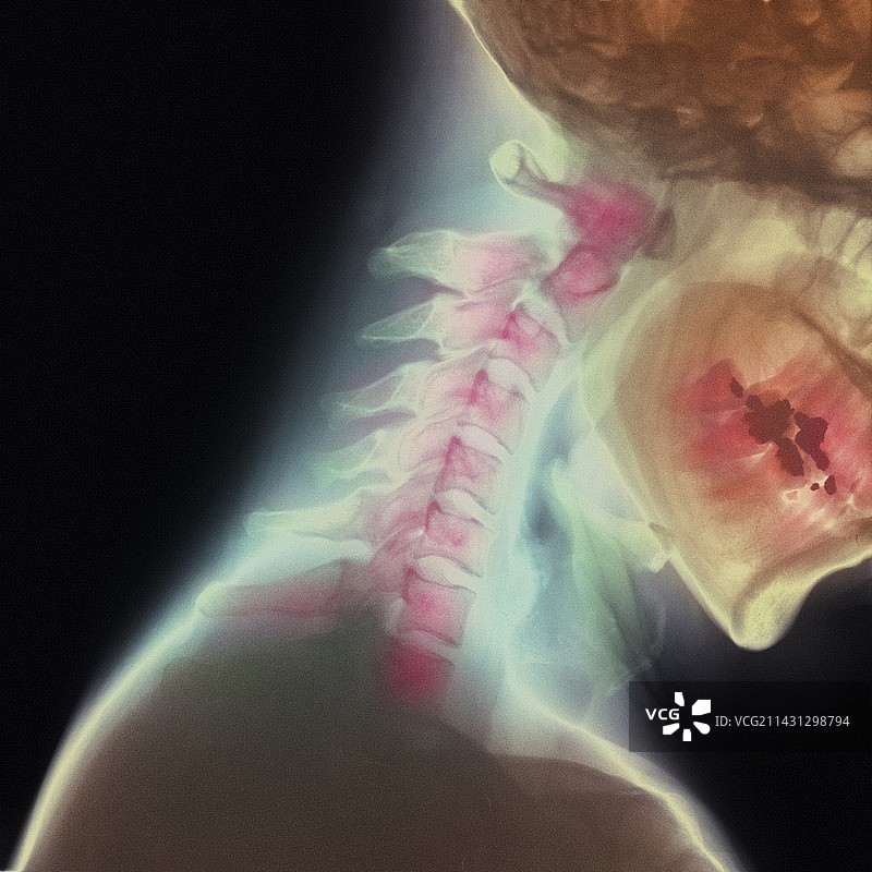 颈部骨折图片素材