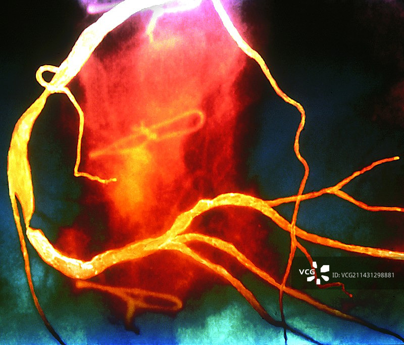 心脏疾病X光片图片素材