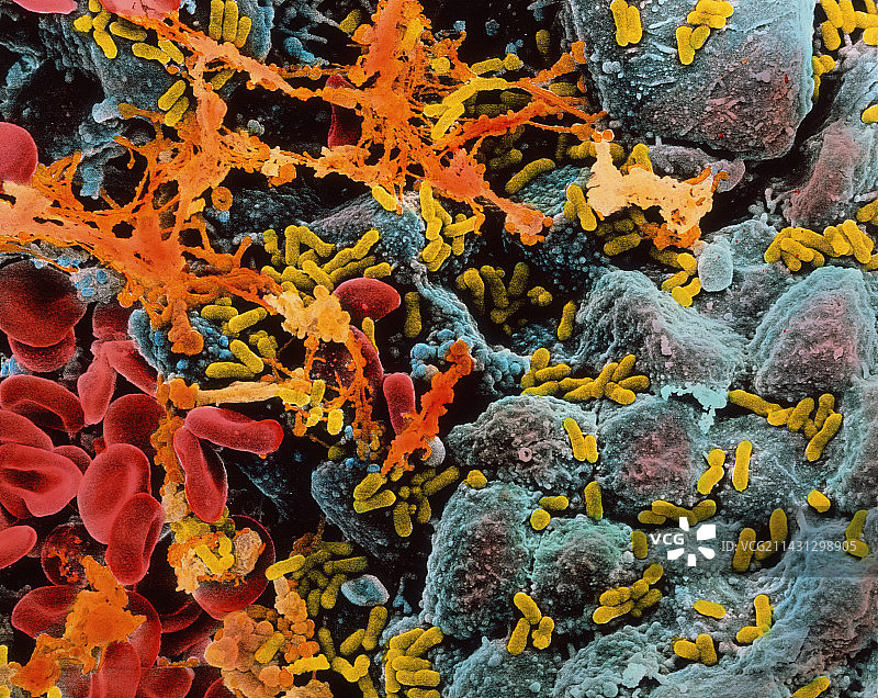 膀胱感染图片素材