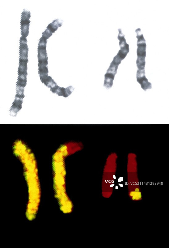 5号和14号染色体易位图片素材