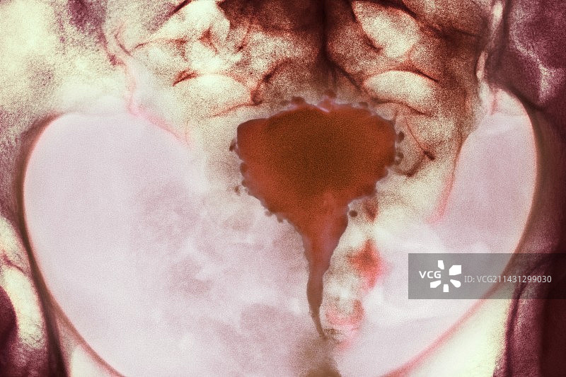 子宫内膜异位症X光片图片素材