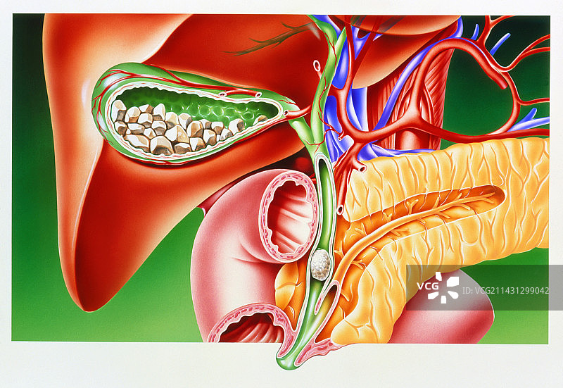 胆囊和胆管中的胆结石图片素材