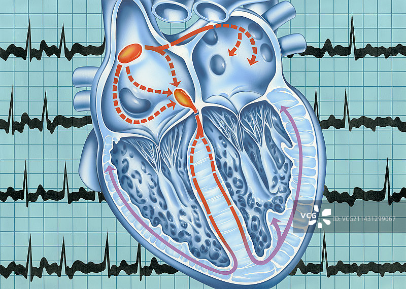 心房颤动图片素材