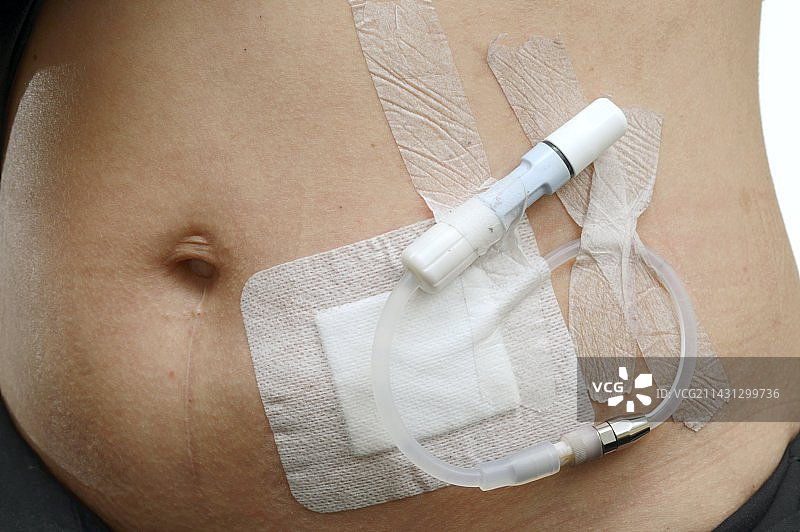 腹部上的腹膜透析部位图片素材