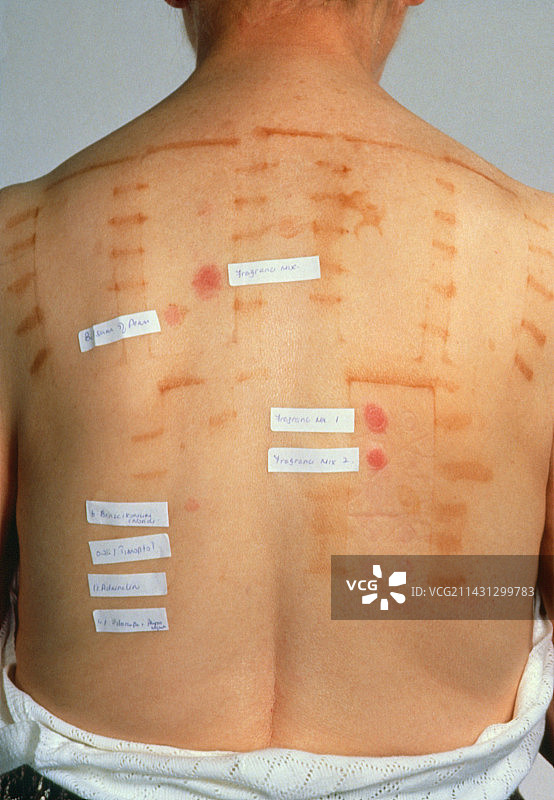 患者背部斑贴试验的结果图片素材