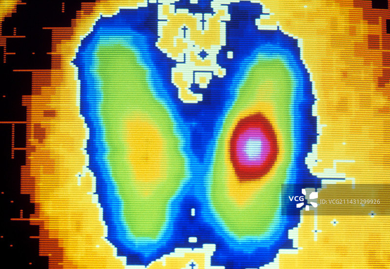 良性甲状腺腺瘤的彩色伽马扫描图片素材