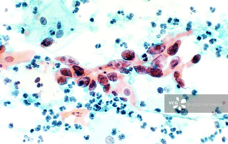 宫颈癌显微照片图片素材