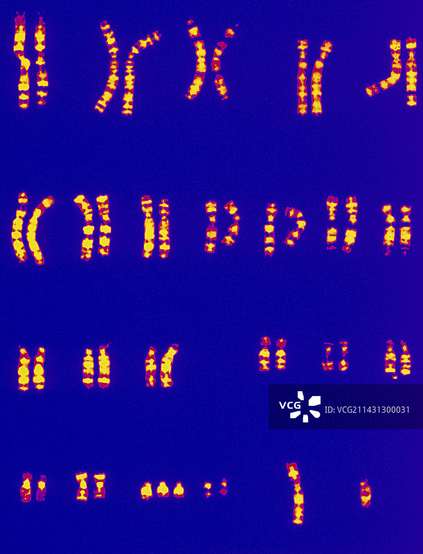 唐氏综合征染色体核型图图片素材