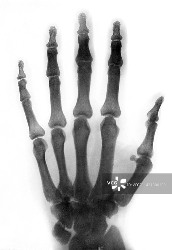1896年手部X光片图片素材